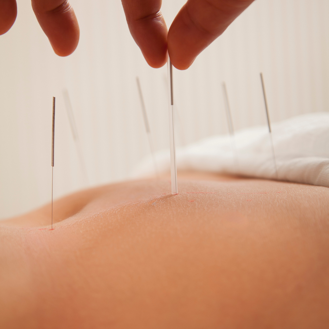 Terapia de Acupuntura